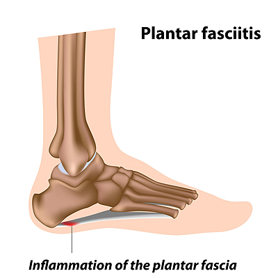 Plantar on sale fascia running